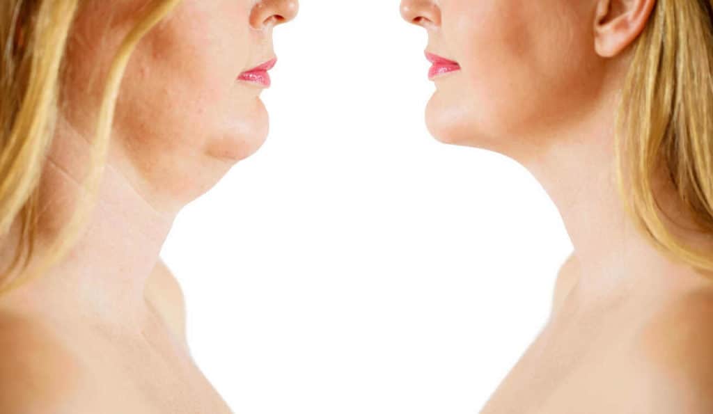 Double Chin treatment King's Heath before and after results