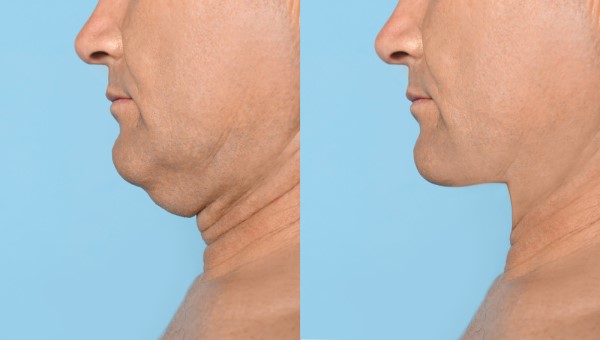 Which Non-Surgical Treatments Work Best for Jowls and Loose Skin King's Heath?