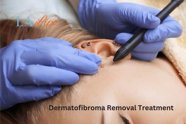 Dermatofibroma Removal Treatment King's Heath