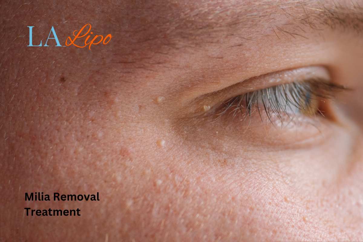 Cryopen Milia Removal: Is It the Easiest and Safest Option King's Heath?