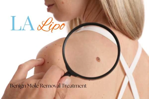 Why getting moles removed King's Heath can boost your confidence!