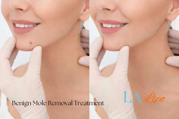 Woman's before and after results of being moles removal treatment King's Heath