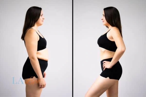 LA-EMS Body Sculpting King's Heath results before and after of womans results on body toning.