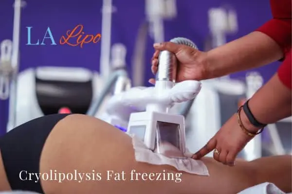 women getting fat freezing King's Heath