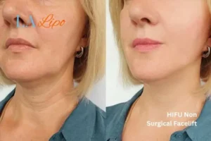 hi-fu for wrinkles King's Heath before and after results