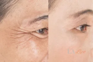 Before and after results of woman - HI-fu wrinkles reduction treatment King's Heath