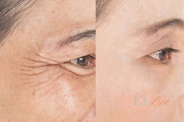 Before and after results of woman - HI-fu wrinkles reduction treatment King's Heath