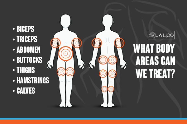 Graphic to show areas you can have LA-EMS Body Sculpting King's Heath treatment.