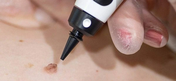 skin tag removal using cryopen King's Heath