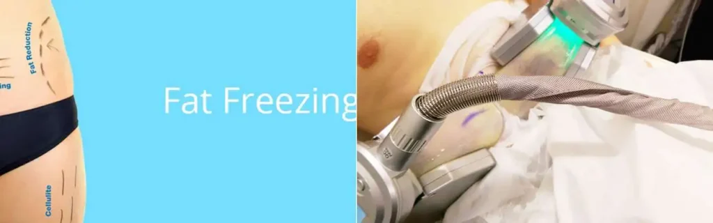 Fat freezing King's Heath on multiple areas of the body