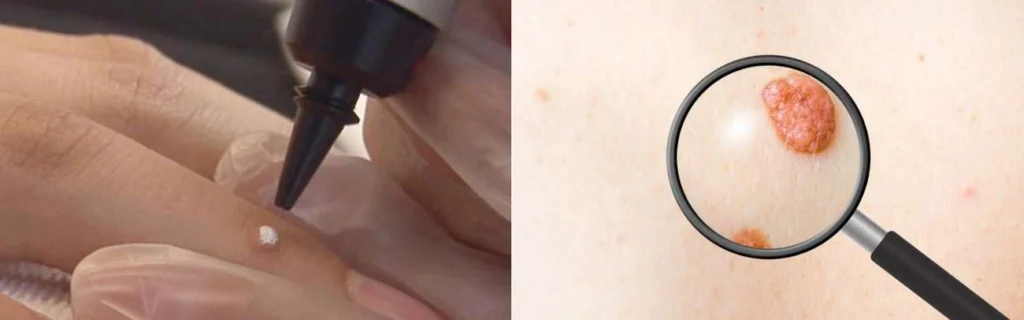 Person getting moles removed with cryopen King's Heath
