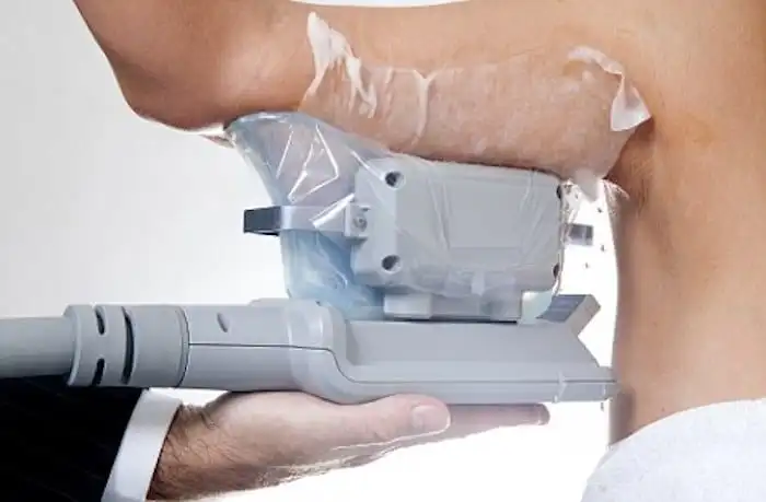 Picture of fat freezing King's Heath on the upper arms.