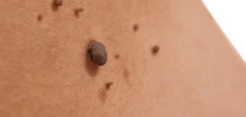 image of a skin tag King's Heath