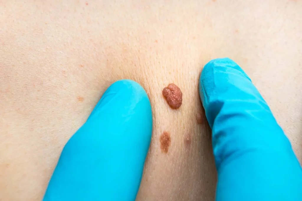 Consultant examining a skin tag King's Heath