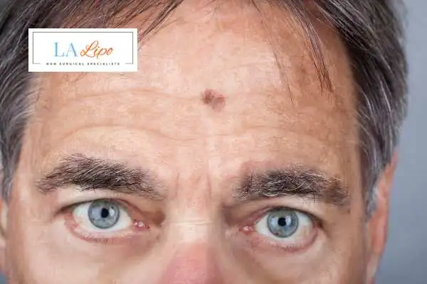 Solar Lentigo Removal King's Heath image of man with mark on his forehead