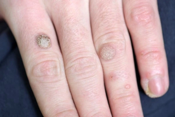 photo of warts on person hand - see wart removal King's Heath from LA LIPO