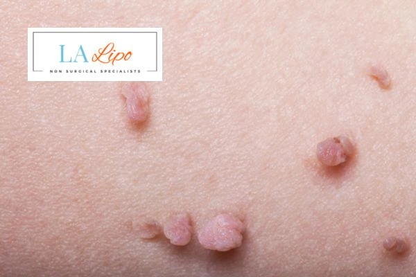 Does cryopen skin tag removal King's Heath hurt? Find out now call our team today!