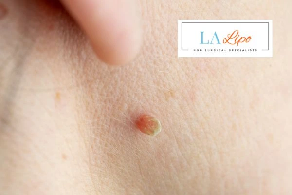 Book skin tag removal King's Heath today speak to our team now!