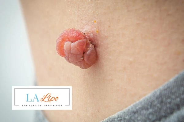 Interested in skin tag removal King's Heath? Concerned about the pain? Find out more today!