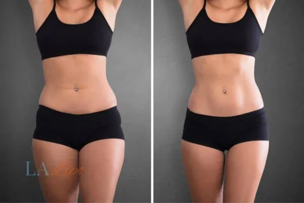 before and after results of non-surgical treatment to help a woman's body image and mental health King's Heath