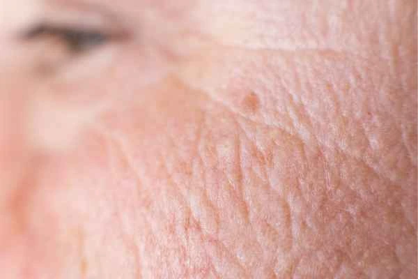 close up picture of a woman's face showing an age spot King's Heath