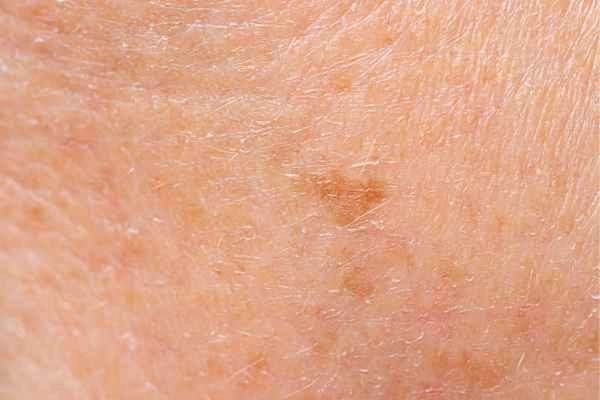 close up picture of age spots King's Heath