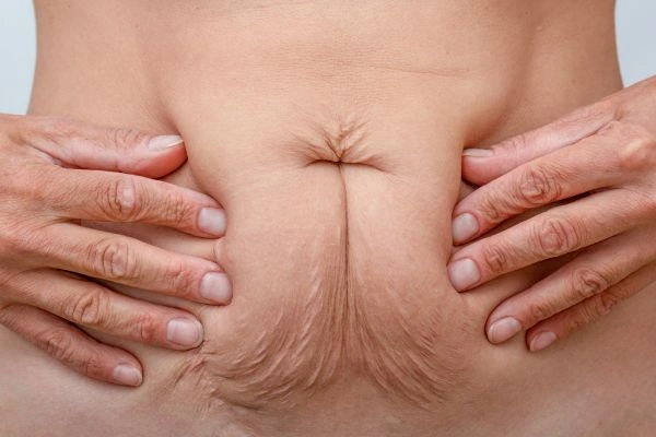 Image of a woman's stomach with loose skin - example of skin tightening King's Heath options
