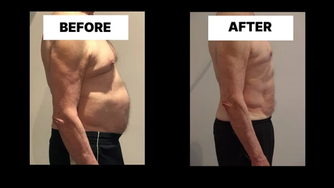 What Symptoms Can Diastasis Recti Cause in Men? Weak Core, Back Pain and Poor Posture King's Heath